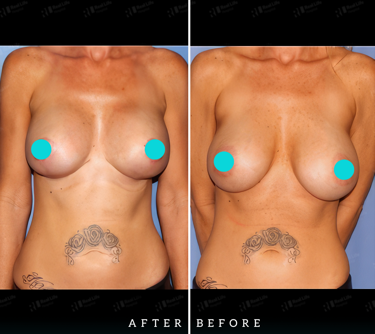 Breast Lift