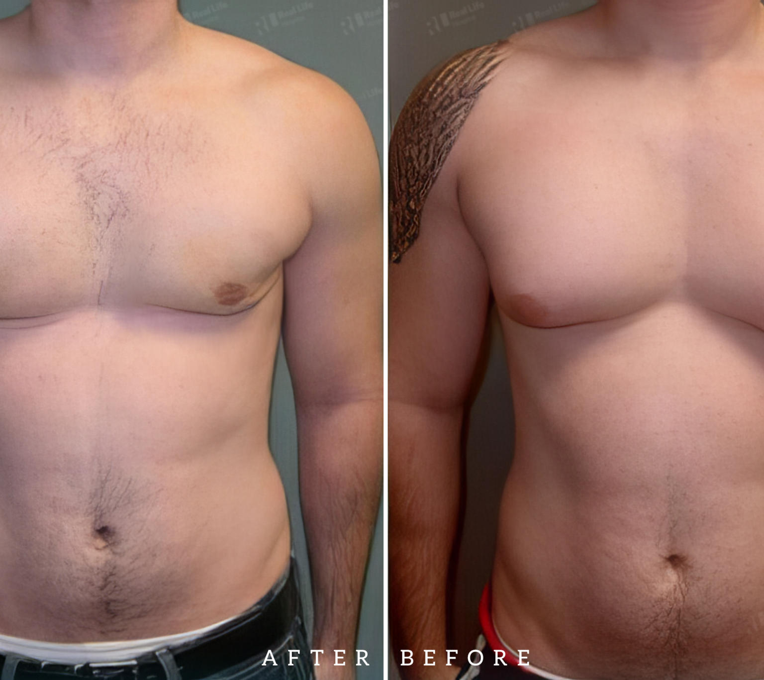 Gynecomastia