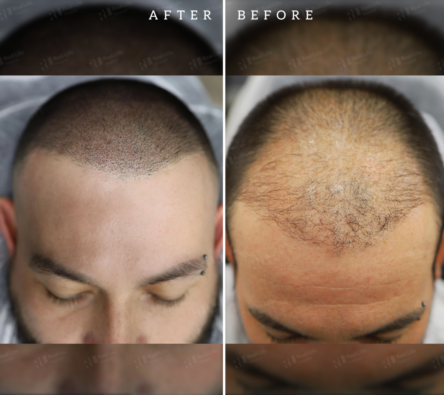 Hair Transplant