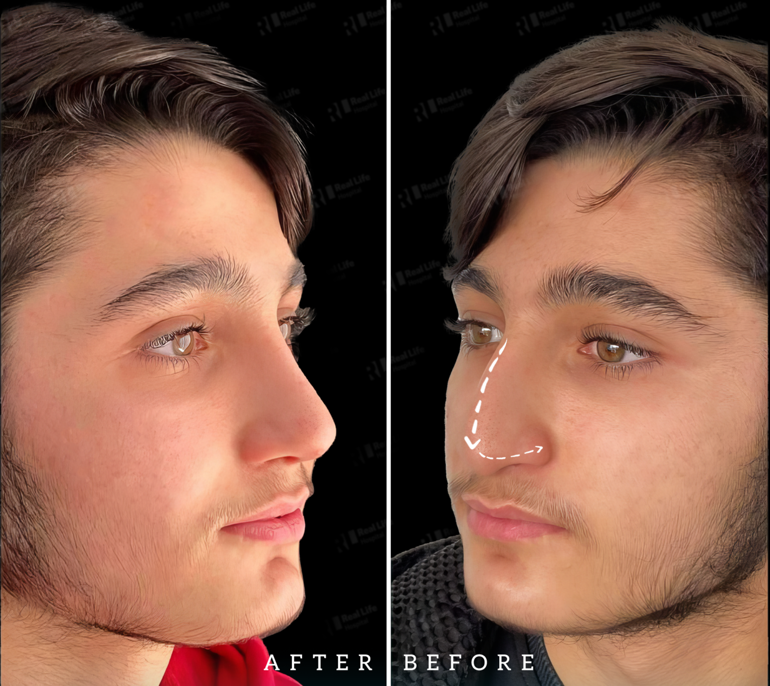 Rhinoplasty