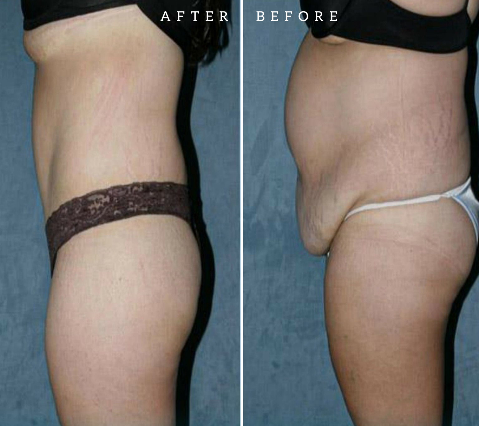 Tummy Tuck