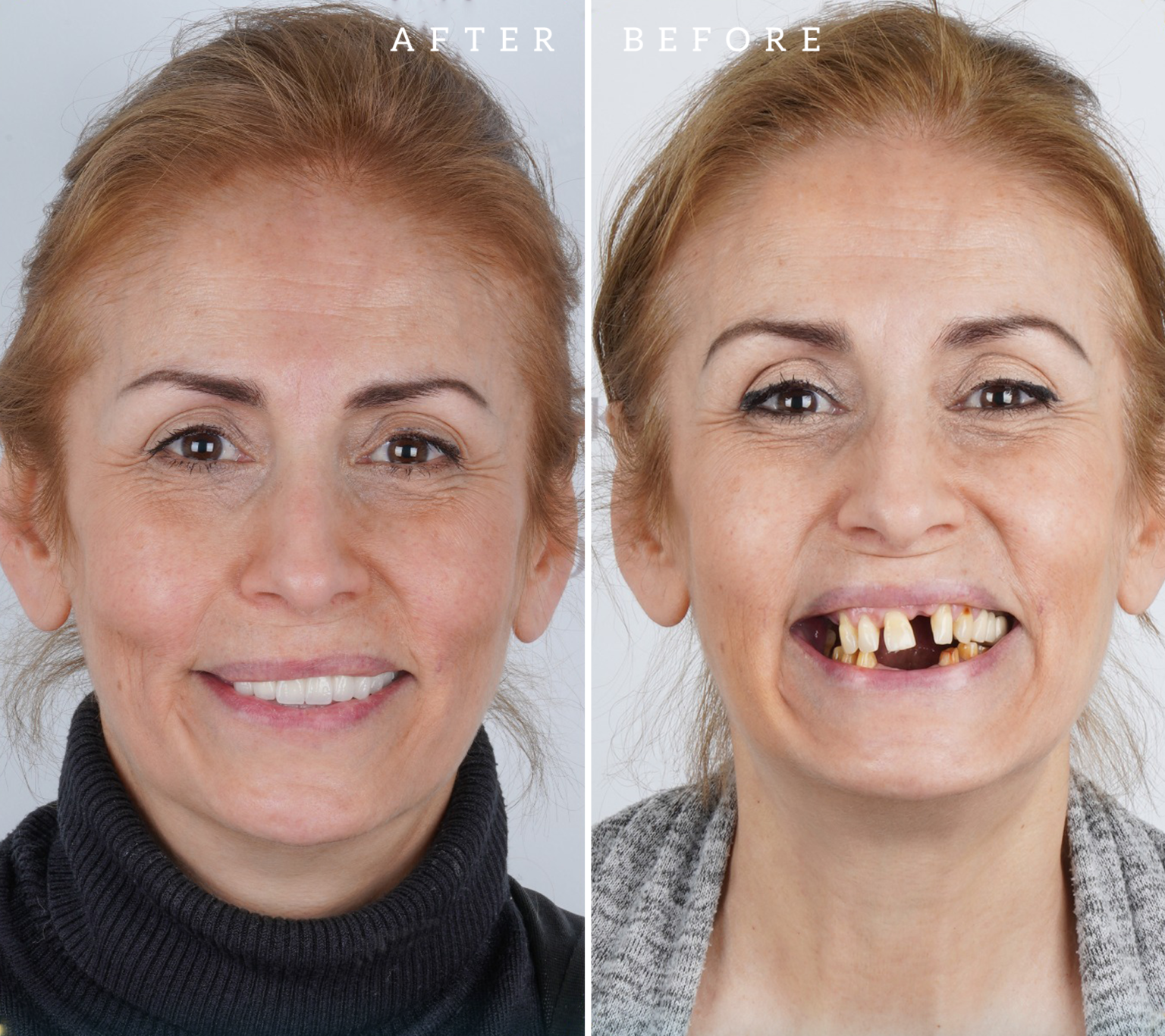 dental implants