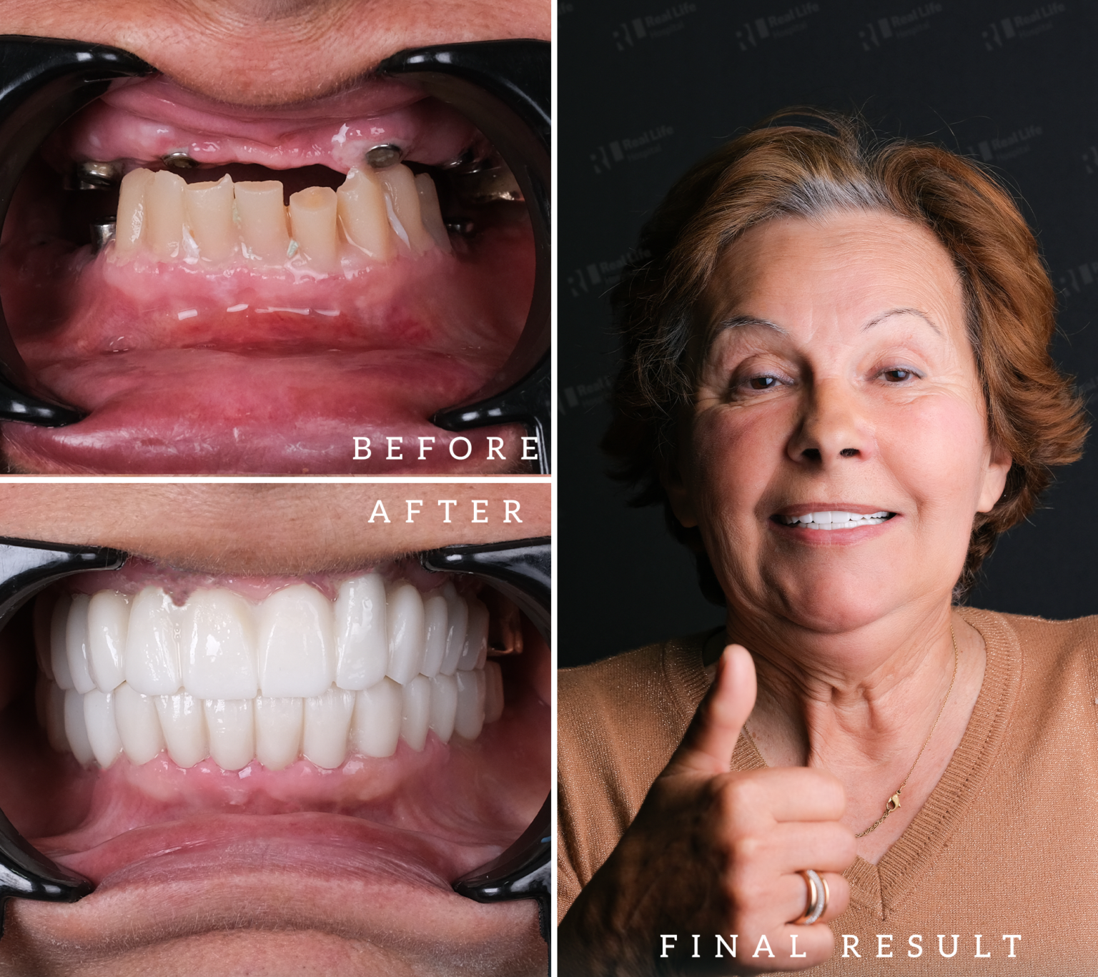 dental implants