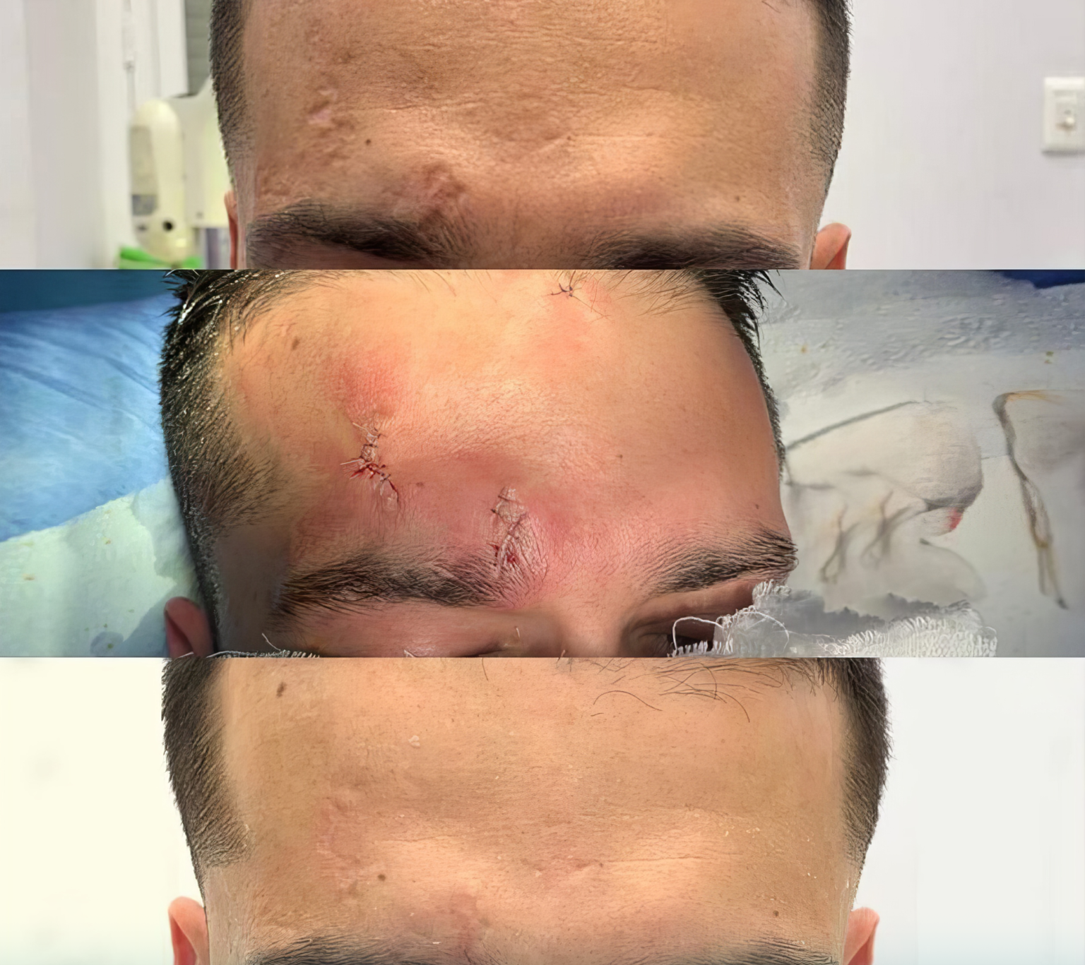 scar revision