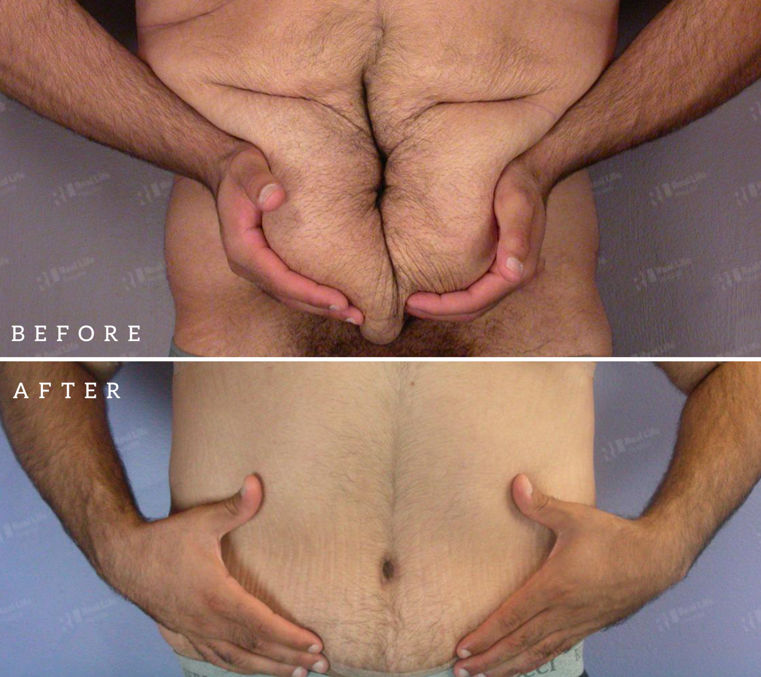 tummy tuck