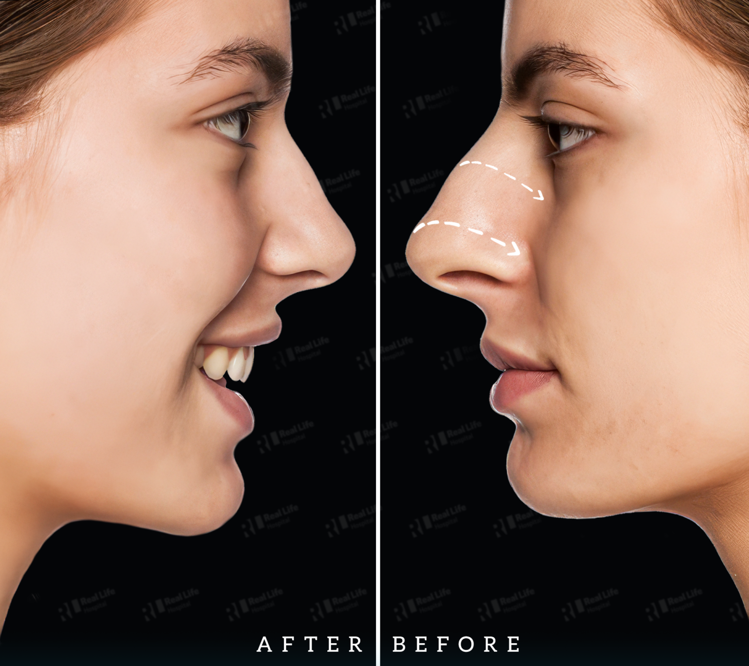 Rhinoplasty