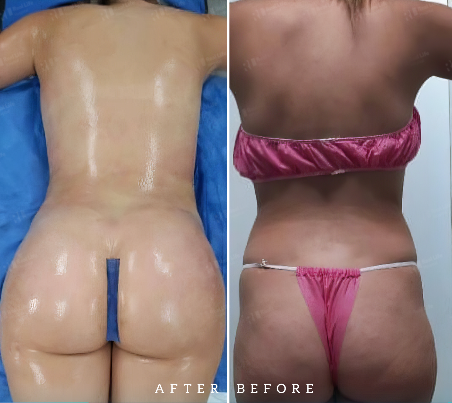 Liposuction